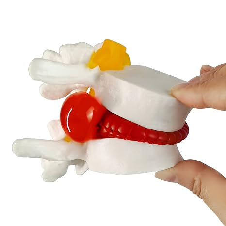 2026 New Human Anatomical Lumbar Herniation Model,Spine Model 1PCS