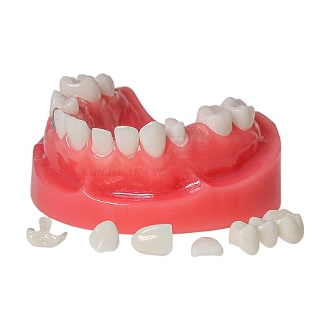 Dental Typodont Teeth Model Dental Restoration Model with Post and Core, Bridge, Implants