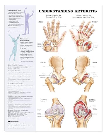 Understanding Arthritis Anatomical Chart